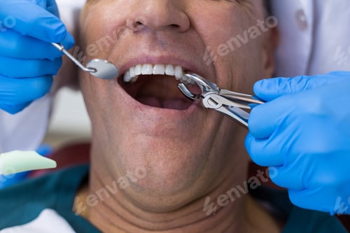 Preview: Dentist using surgical pliers to remove a decaying tooth