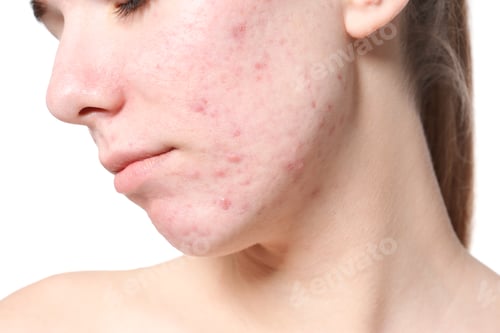 Preview: Young woman with acne problem on white background