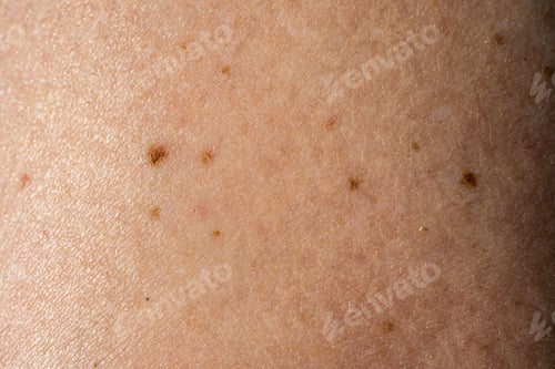 Preview: Macro shot of the human skin with nevi, moles.
