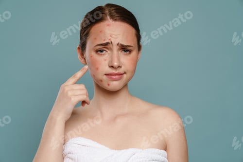 Preview: Ginger woman wearing towel pointing finger at her pimples