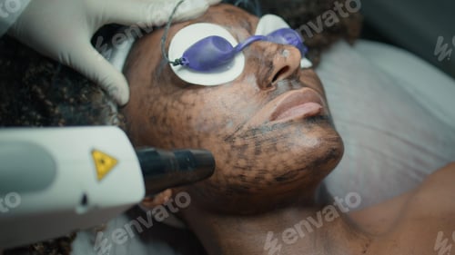 Preview: Closeup face peeling procedure with laser equipment. Cosmetician treating skin