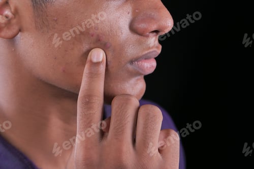 Preview: close up of young man face with skin problem .