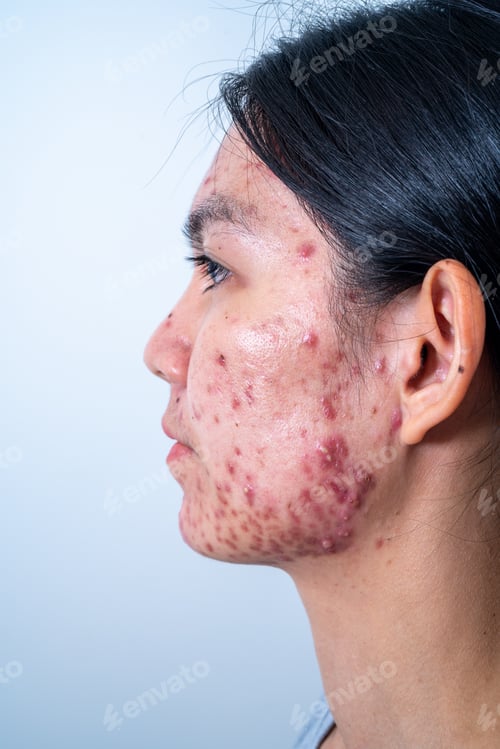 Preview: Acne on face because the disorders of sebaceous glands productions. Acne or a Cosmetic