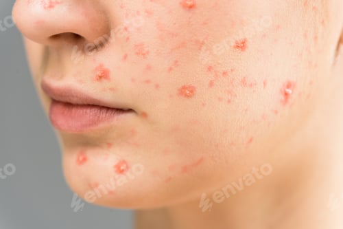 Preview: close up of young woman with pimples on face isolated on grey