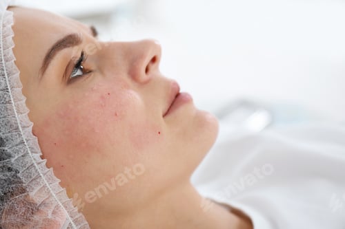 Preview: Woman after face biorevitalization procedure in salon, closeup. Cosmetic treatment