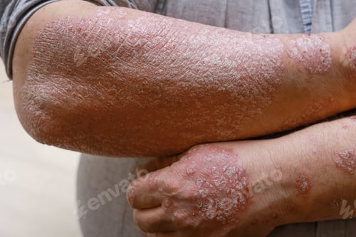 Preview: Psoriasis skin with red wounds. Male arms with cracked, hard, horny, flaky skin. Dermatological pr