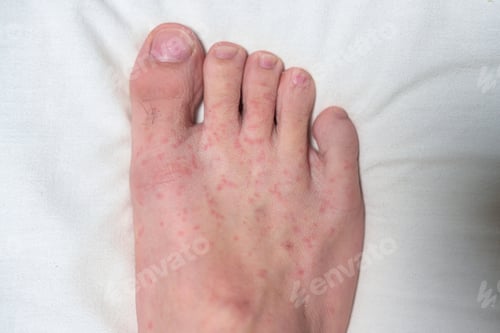 Preview: Allergic reaction, Red rash itychy on foot