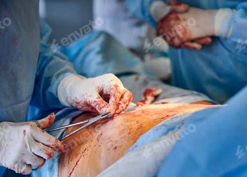 Preview: Doctor hands stitching up wound after abdominoplasty surgery.