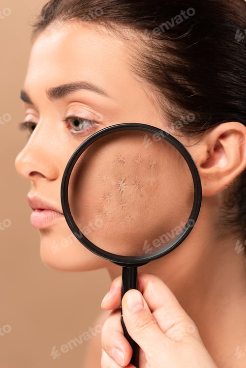 Preview: cropped view of man holding magnifier near girl with acne isolated on beige