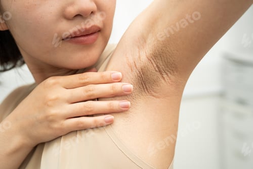 Preview: Asian woman have problem black armpit beauty skin care.