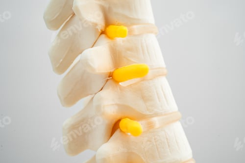 Preview: Lumbar spine displaced herniated disc fragment, spinal nerve and bone. Model