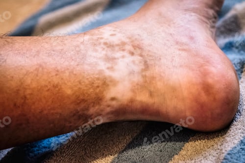 Preview: Closed plane of an ankle with lack of skin pigmentation.
