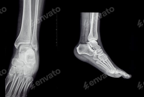 Preview: An x-ray of the human foot and ankle