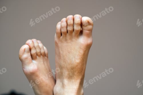 Preview: Closeup of woman feet sole with dry cracked skin. Foot and toes care concept