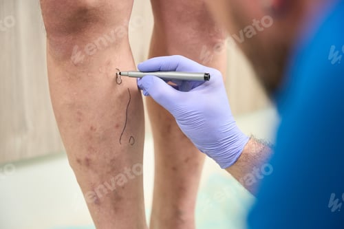Preview: Men legs in which doctor circles varicose veins with marker