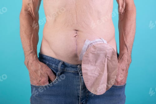 Preview: stoma care