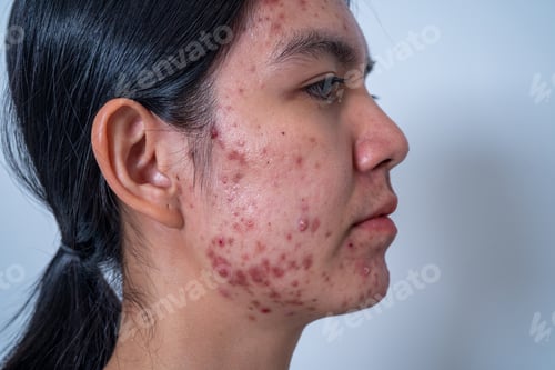 Preview: Acne on face because the disorders of sebaceous glands productions. Acne or a Cosmetic