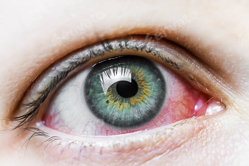 Preview: Close up of a severe bloodshot red eye. Viral Blepharitis, Conjunctivitis, Adenoviruses. Irritated