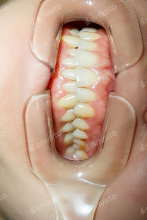 Preview: Close-up teeth, dental treatment at the dentist. Oral cavity care