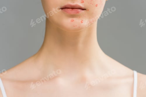 Preview: cropped view of young woman with pimples on face isolated on grey