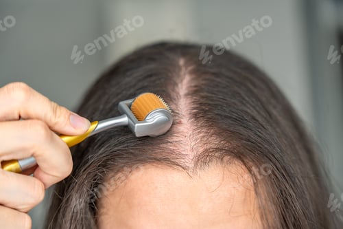 Preview: Close up view of young woman using microneedle derma roller on head for stimulating new hair growth