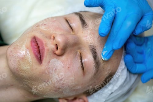 Preview: Acne treatment in a teenager.