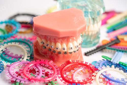 Preview: Orthodontic ligatures rings and ties, elastic rubber bands on orthodontic braces,
