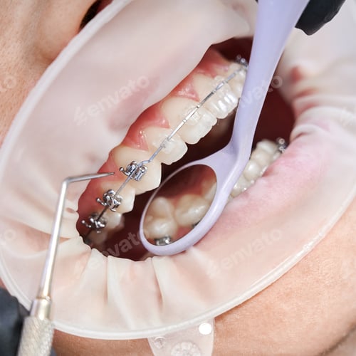 Preview: Dentist attaching metal braces to patient teeth.