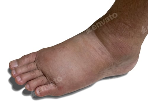 Preview: Close-up Swollen Left Foot as a Result of Ankle Pain Isolated on White