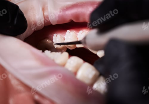 Preview: Dentist attaching white braces to patient teeth.