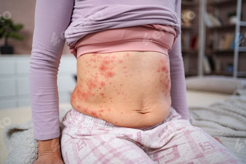 Preview: Woman's abdomen showing red rash, skin irritation, and allergy symptoms