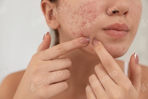 Preview: Teen girl with acne problem squeezing pimple on her face, closeup