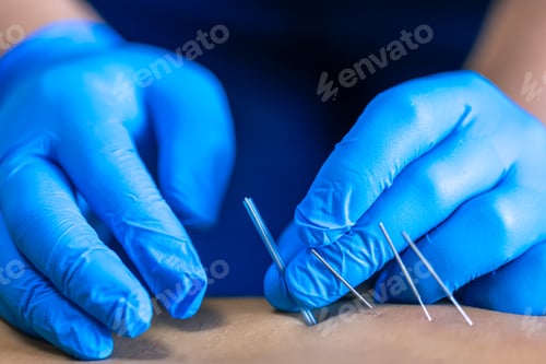 Preview: Close up of a needle and hands of physiotherapist doing a dry needling.