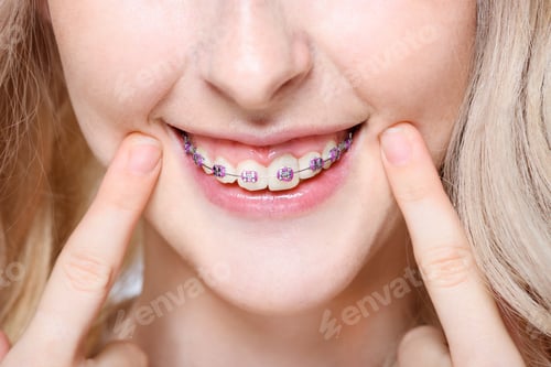 Preview: Closeup of a young woman pointing to her teeth with braces.