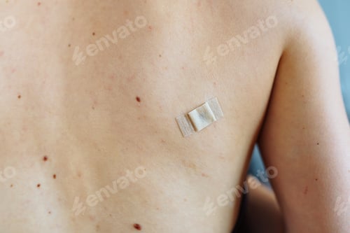 Preview: tick bite wound on back, medical plaster on skin back, anti-inflammatory