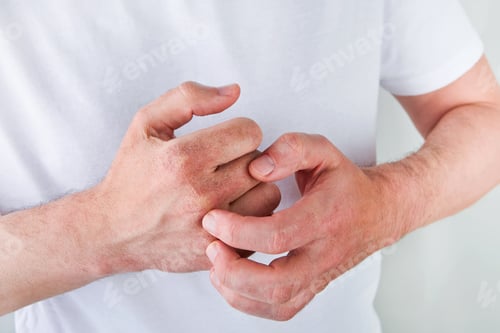 Preview: Man scratches or shows hands with dry, cracked skin on white backgrounds. Problem with many people -