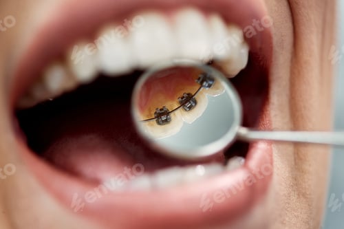 Preview: Close-up of woman having lingual braces check-up by orthodontist at dentist's office.