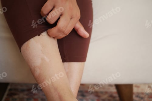Preview: feet with vitiligo skin condition.
