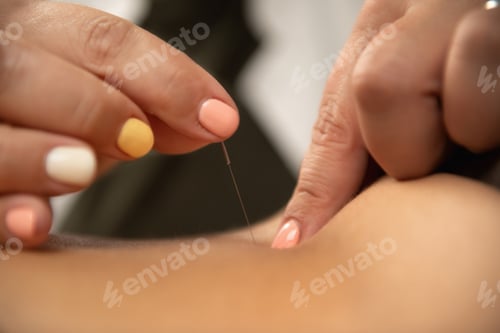 Preview: Acupuncture for Ischialgia Back Pain