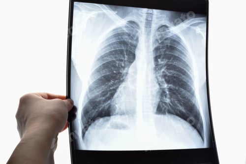 Preview: Lung X-ray.