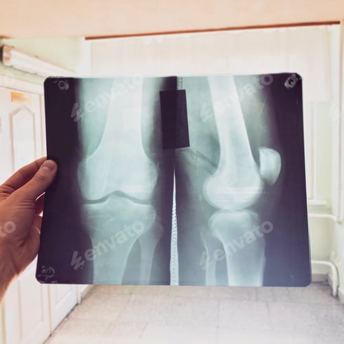 Preview: X-ray film of mans knee