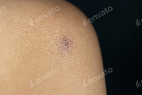 Preview: Marks after laser hair or scar removal from the skin. CO2 technique.
