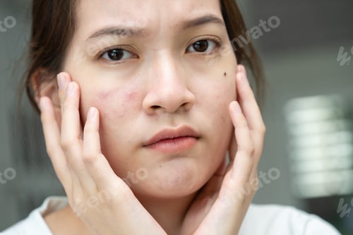 Preview: Asian young with pimple, acne, scar on skin, facial problem.