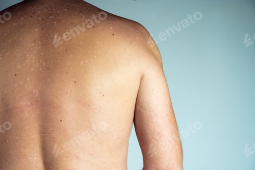 Preview: Close-up of red inflamed flaky itchy skin of bare back with blemishes of unrecognizable man sufferin