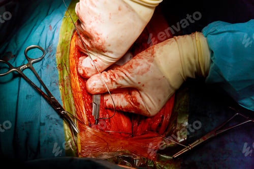 Preview: Surgeon hands the open heart surgery procedure