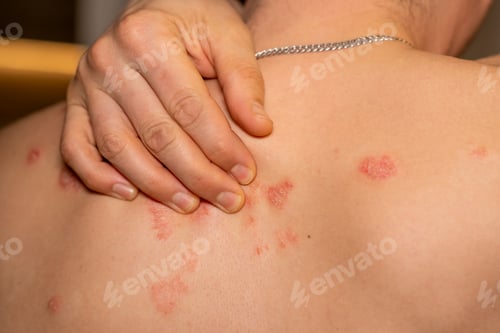 Preview: Psoriasis manifests as itchy, scaly patches on the skin, affecting individuals with this genetic