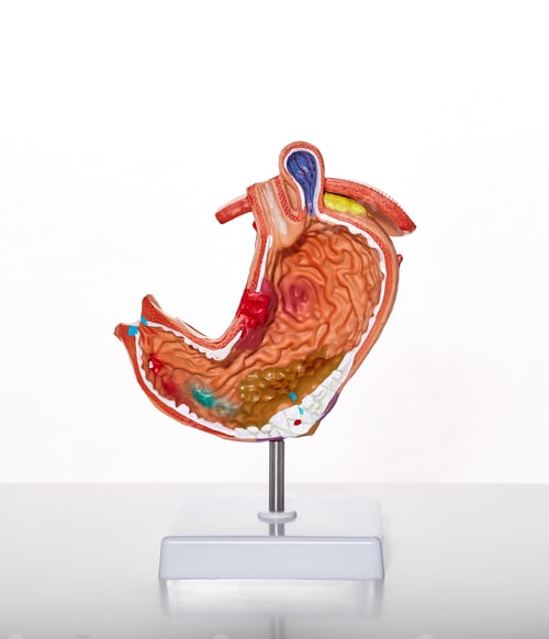 Preview: Visual anatomical model of stomach showing stomach pathologies and disease, ulcer and gastritis for