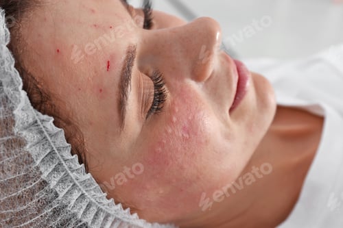 Preview: Woman after face biorevitalization procedure in salon, closeup. Cosmetic treatment