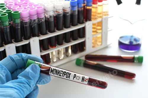 Preview: A medical worker lab technician holding a vial of blood to tested for the monkeypox virus – negative