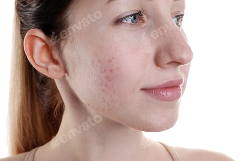 Preview: Young woman with acne problem on white background, closeup